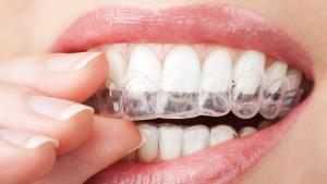 apparecchio-invisibile-chivasso-dentista